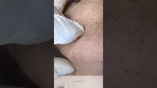 Acne Extraction In Action [upl. by Hutchings]