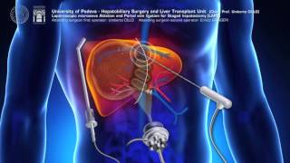 Modified ALPPS totally laparoscopic LAPS  ALPPS modificata LAPS totalmente laparoscopica [upl. by Estey]