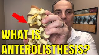 Ep61 What Does Anterolisthesis Of L5 Mean  Dr Walter Salubro Chiropractor in Vaughan [upl. by Kcaj892]