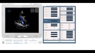 Assessment of Mitral Regurgitation using regurgitation area by Echocardiography online simulator [upl. by Phedra]