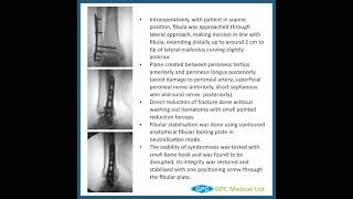 Ankle Fracture Series Management Technique for Lateral Malleolar Fractures  GAITS Academy [upl. by Aicert]