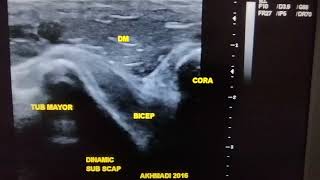 Dynamic Ultrasound in Shoulder Impingement [upl. by Theodoric]