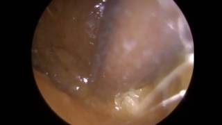 273  Ear Wax Removal Difficult Case with Ear Wax Stuck in Anterior Recess near Eardrum [upl. by Martica946]