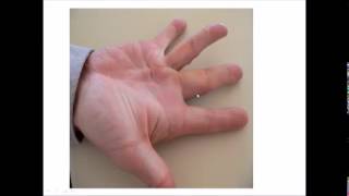 rheumatoid hand examination [upl. by Ymmit]