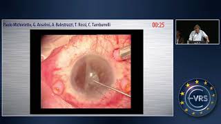 Vitrectomy for Endophthalmitis in 119 Eyes at Ophthalmic Hospital of Rome Italy from 2011 to 2016 [upl. by Yrrat]