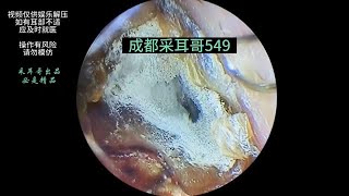 Hard cerumen embolism fungal infection ｜549 [upl. by Benis632]