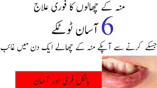 Munh Ke Chalon Ka fori Ilaj Mouth Blister [upl. by Faires]