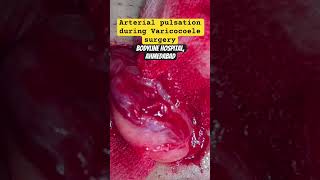 Testicular Artery pulsation during Varicocoele surgery varicoceletreatment andrologist urologist [upl. by Joelie]