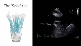 TEE Essentials Mastering the midesophageal left atrial appendage view [upl. by Rukna]