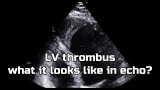 Apical thrombus Left ventricle [upl. by Annoyed]