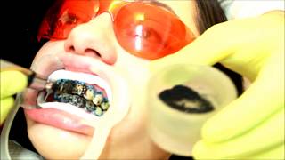 Los secretos de un blanqueamiento dental  secret smile [upl. by Rolyt]