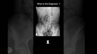 Appendicolith Abdominal Xray  Abnormal calcification 54 radiologychannel007 [upl. by Nicoline]