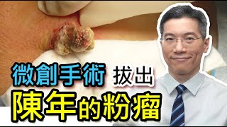 長者  背部長的腫瘤  陳年的粉瘤  Sebaceous Cyst  Epidermoid Cyst  微創手術  皮膚專科 [upl. by Regdor]