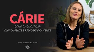 Como diagnosticar clinicamente e radiograficamente a cárie [upl. by Sluiter]