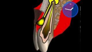 Dentale fistola  Granuloma dentale [upl. by Enneiviv759]