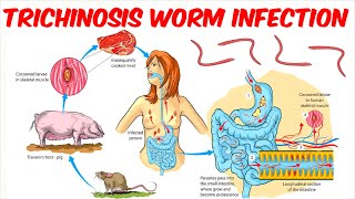 Trichinosis Trichinellosis Worm Infection [upl. by Krystyna874]