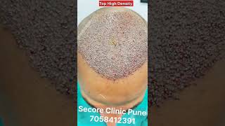 Top 15 Surgery Hair Transplant amp Tue Hair Transplant viralvideos instagram short shortvideo [upl. by Loux]