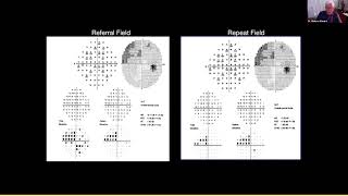 Lecture Advanced Perimetry Interpretation Recognizing and Dealing With Artifacts [upl. by James]