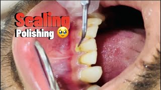 Scaling of anterior teeth with ultra scaler 🥹🇵🇰  Teeth whitening procedure [upl. by Oicneserc536]