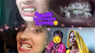 Braces journey experiencevideo Metalbraces😔मेsadiकेbadh braces kyu lagbai🥺experienceinhindi 👍🙏 [upl. by Milah]