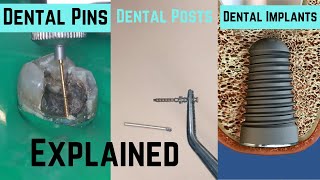 Whats the difference between dental pins posts and implants [upl. by Base288]