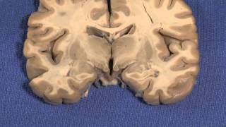 Hypothalamus Neuroanatomy Video Lab  Brain Dissections [upl. by Nilloc]