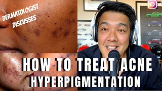 How to treat ACNE PIGMENTATION  PIH [upl. by Toscano464]