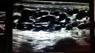 Varicocele Radiopaedia  Varicocele Grade  Scrotal Ultrasound [upl. by Aneret]