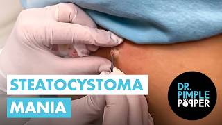 Steatocystoma Mania [upl. by Atinauq]