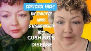 Cortisol Face Living and Losing Weight with Cushings DiseaseSyndrome [upl. by Jess596]