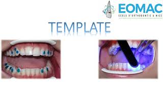 Template Invisalign [upl. by Leonhard]