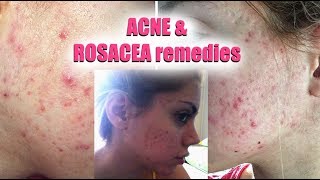 HOW TO GET RID OF ACNE AND ROSACEA  Pershii [upl. by Cthrine]