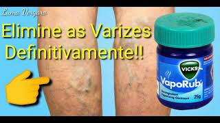 🔴ELIMINE as VARIZES DEFINITIVAMENTE com ESSE PRODUTO [upl. by Eiramllij]