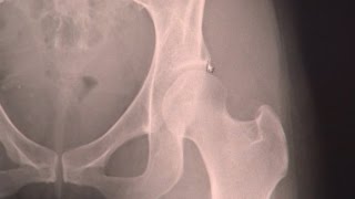 Hip Dysplasia amp Surgery [upl. by Hadleigh]