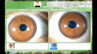 Iridology Camera 9822U software operation Video 3201 Version [upl. by Mazurek]