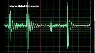 Post Pulsatile Glenn Procedure normal speed [upl. by Akemahs]