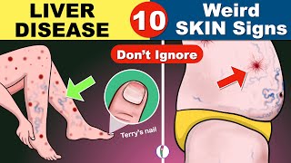 10 Skin signs of Liver Disease  Fatty liver  Cirrhosis of the Liver  Fatty liver Symptoms [upl. by Regine]