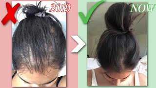 HOW I GREW MY HAIR BACK NATURALLY  QampA BEFORE amp AFTERS HAIR LOSS STORY  RESULTS IN JUST 1 MONTH [upl. by Erodasi]