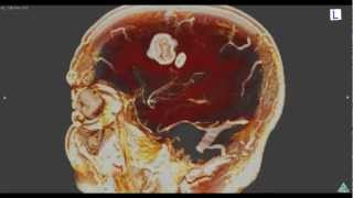 Brain Tumor 3D MRI：脳腫瘍を造影してみた [upl. by Efeek]