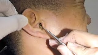 One Hard Earwax Removed form Mans Ear [upl. by Effie]