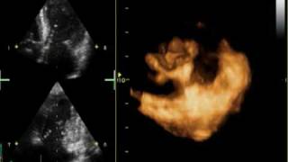 3D MITRAL REGURGITATION PROLAPSE P2 AND P3 [upl. by Bollay915]