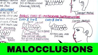 Angles Classification of Malocclusion  Orthodontics [upl. by Ilise14]