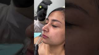 Botox Nose Lift [upl. by Mot]