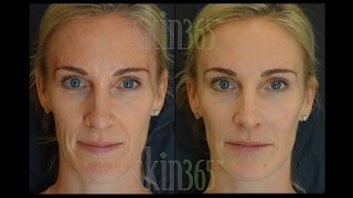 Radiesse quotDermal Fillerquot immediate results and stimulates collagen to grow [upl. by Sirdi]