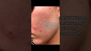 My ACNE Journey accutane acne clearskin [upl. by Keeley803]