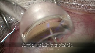 Combined cataract surgery with iStent Inject W quotWidequot glaucoma device implantation [upl. by Llehcam]