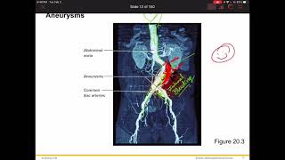 APII The Blood Vessels aneurysm basics 1 [upl. by Gnaig401]