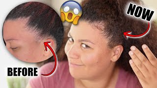 Unbelievable hair growth in just 30 DAYS 😱 My edges grew back with this ALLNATURAL product [upl. by Darce]