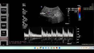 Triphasic CCA waveformIs this a problemCarotid Doppler Case [upl. by Arim886]