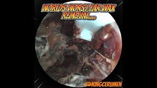 Most Disgusting Ear Wax Removal [upl. by Zillah]